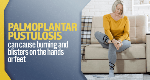 Woman sitting on couch holding her foot. Palmoplantar pustulosis can cause burning in the hands or feet